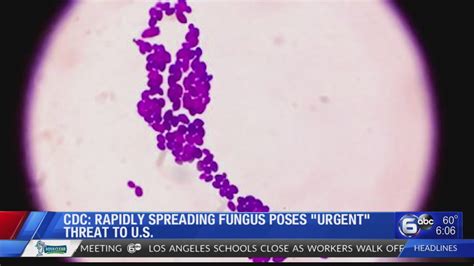 CDC: Fast-spreading fungus already in New York presents 'urgent' threat